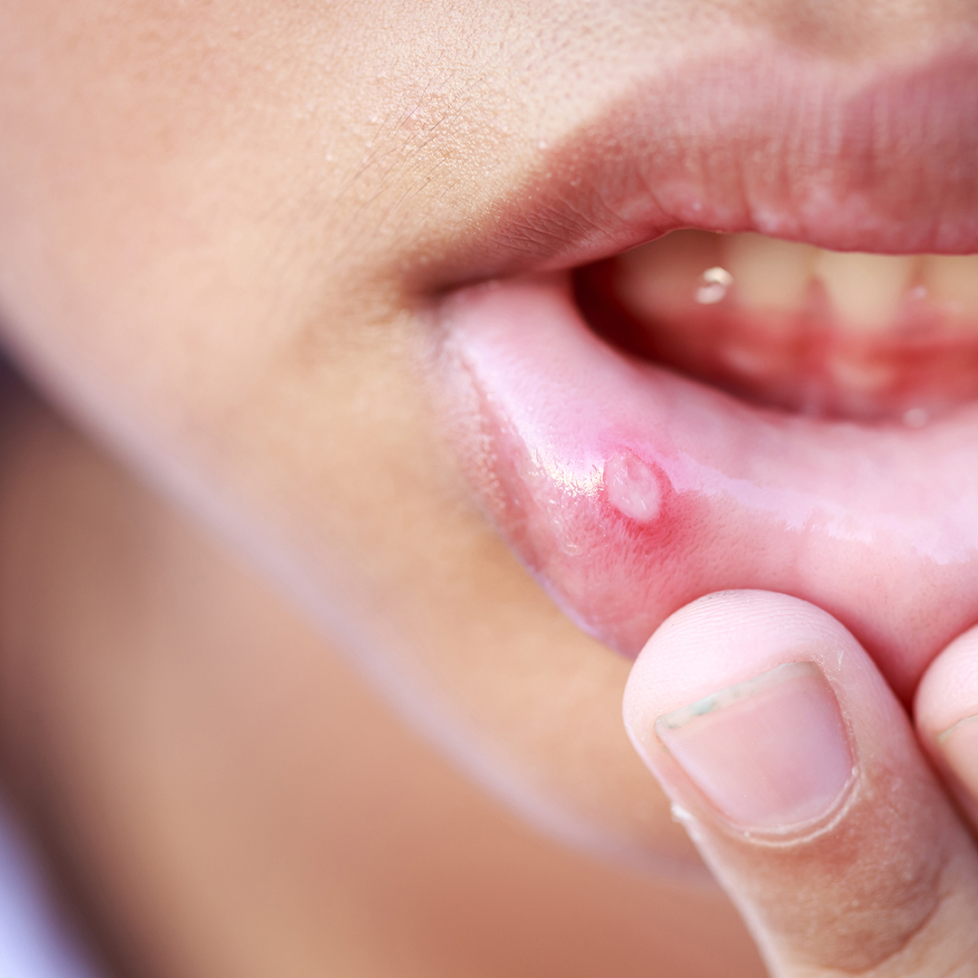 alergia alimentaria llagas en la boca